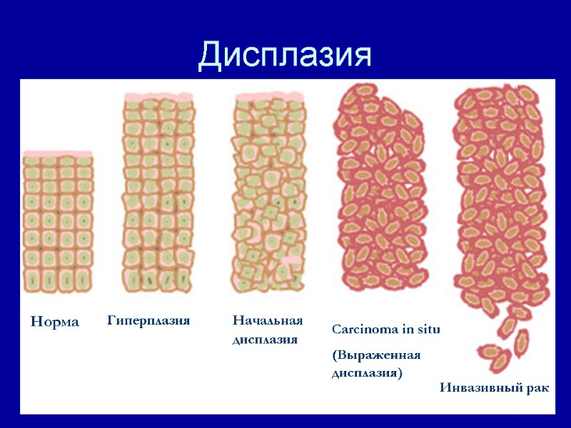 Дисплазия Норма Гиперплазия Начальная дисплазия Carcinoma in situ (Выраженная дисплазия) Инвазивный рак